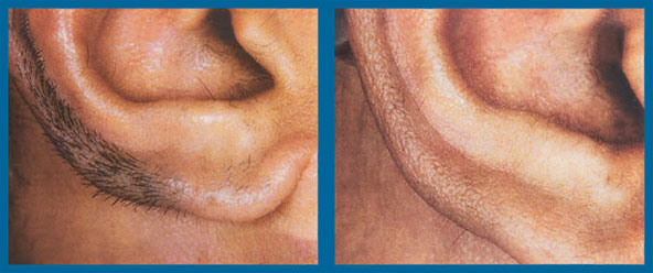 Before &amp; After Tampa Laser Hair Removal
