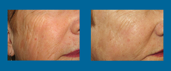 before & after laser treatment