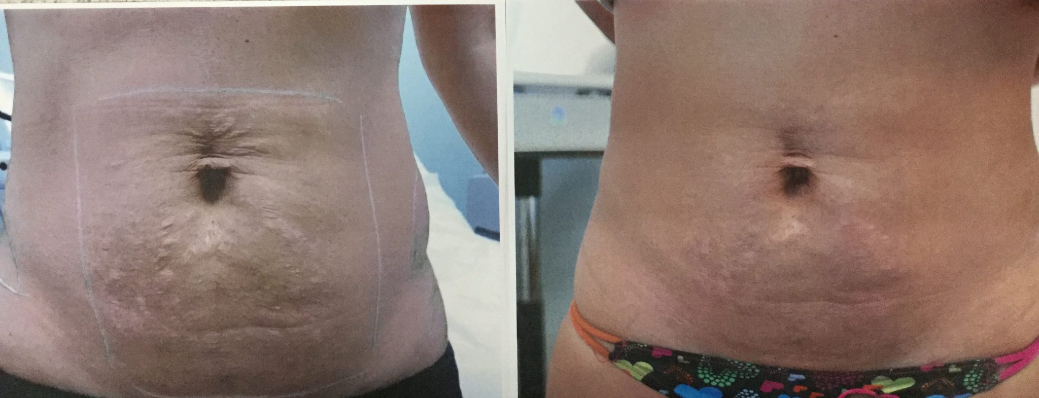 before & after laser treatment