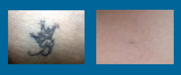tattoo removal before & after