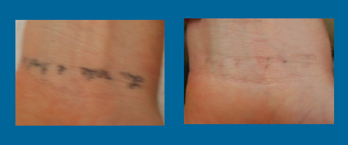 tattoo removal before & after
