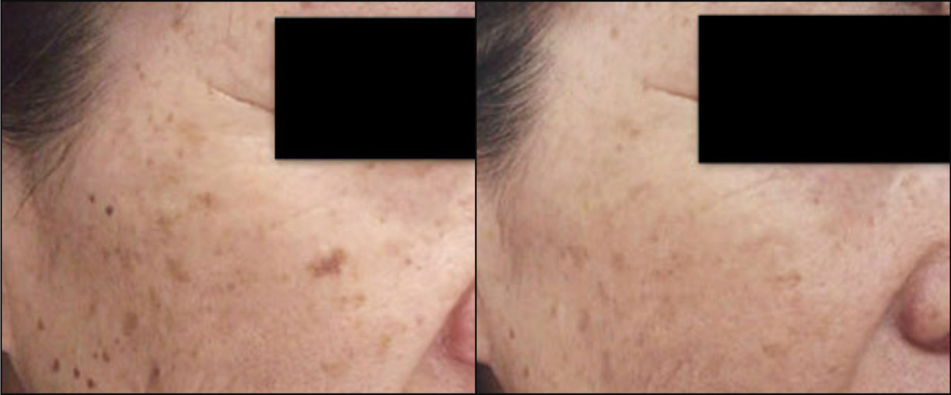 Age Spots - Before & After
