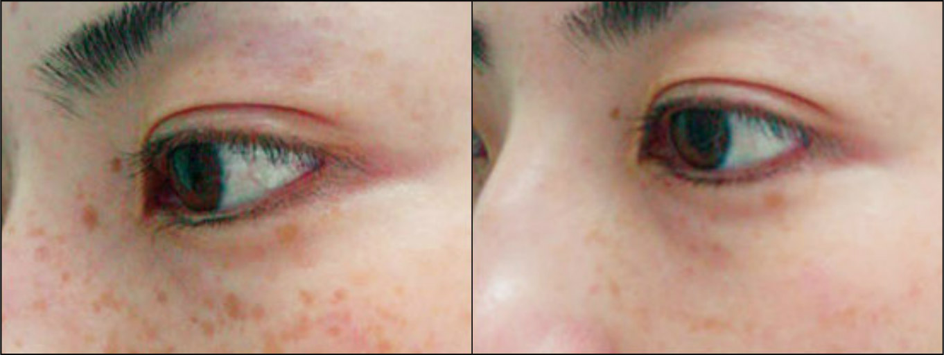Freckles - Before & After