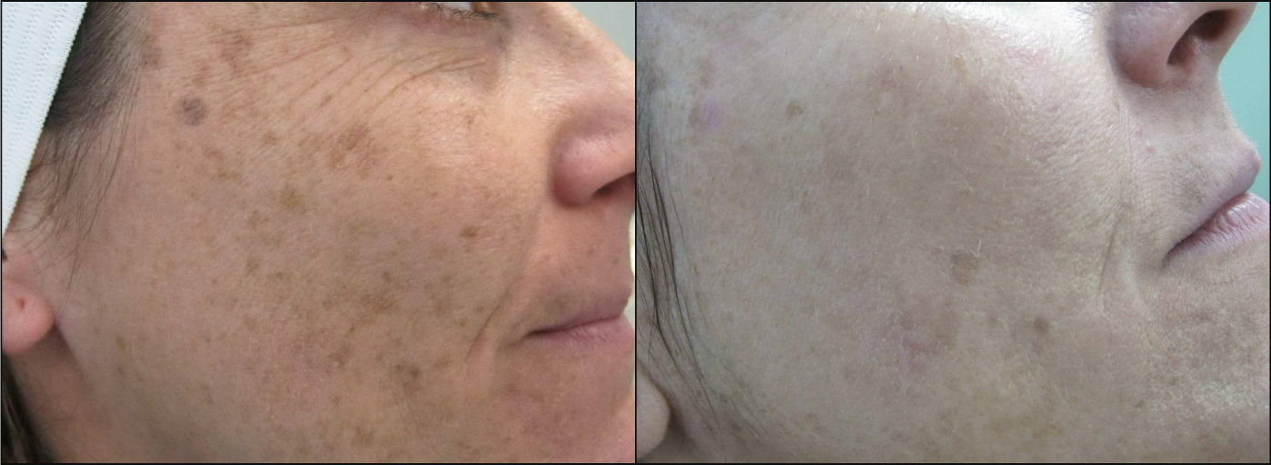 Pigmented Lesion Treatment - Before & After
