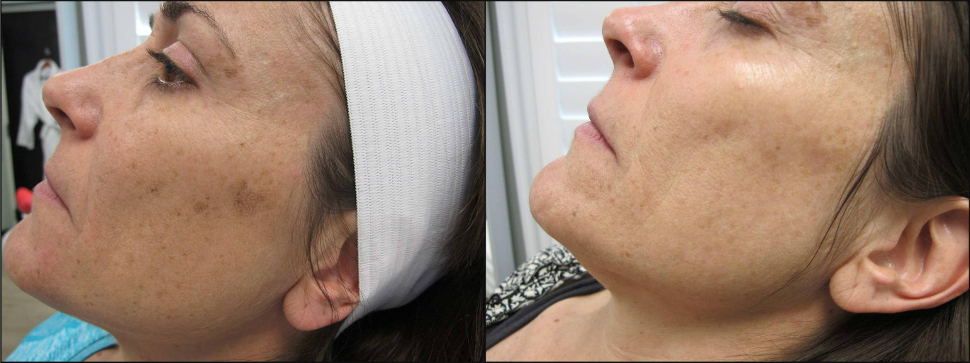 Pigmented Lesions - Before & After