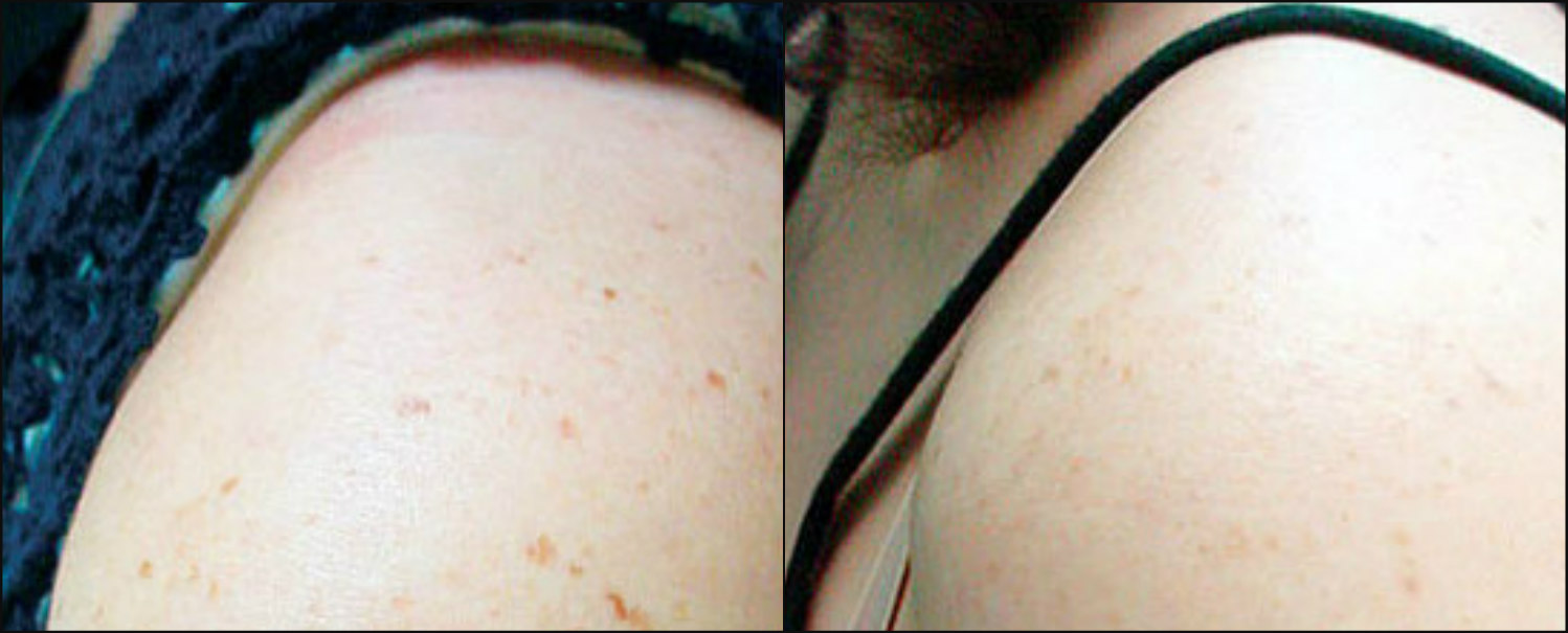 Pigmented Lesions on Shoulder - Before & After