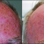 Pigment - Before After Forehead