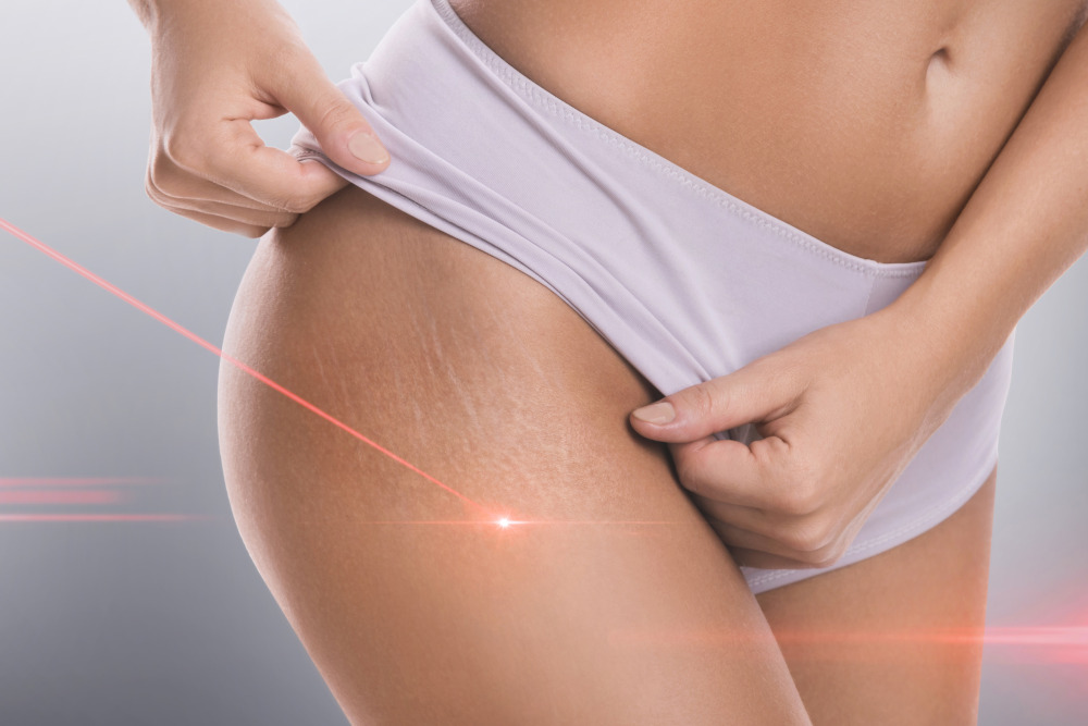 Close-up of female hips with a stretch marks during laser removal session treatment