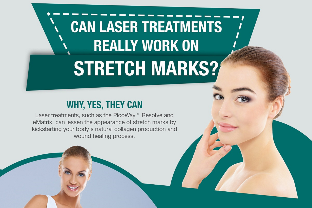Can Laser Treatments Really Work on Stretch Marks [Infographic]