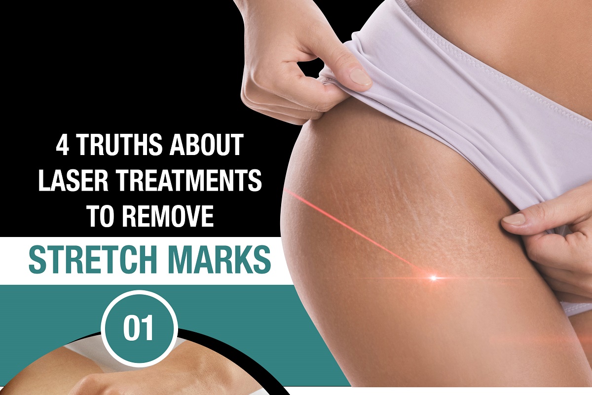 4 Truths About Laser Treatments to Remove Stretch Marks [Infographic]