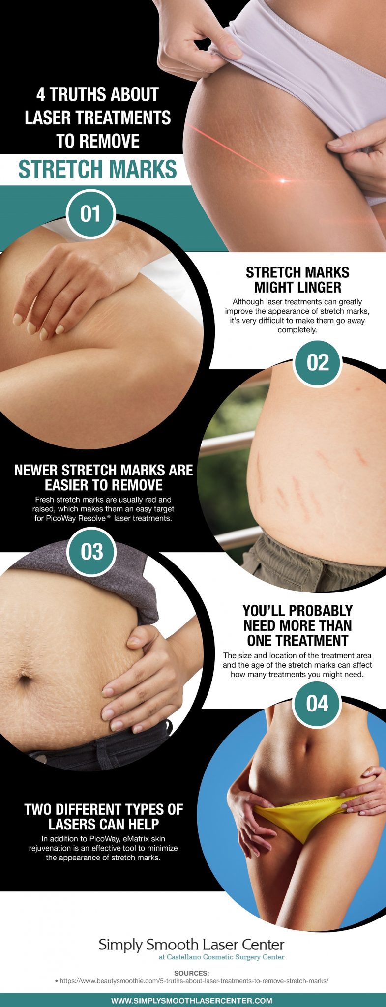 4 Truths About Laser Treatments To Remove Stretch Marks [Infographic]